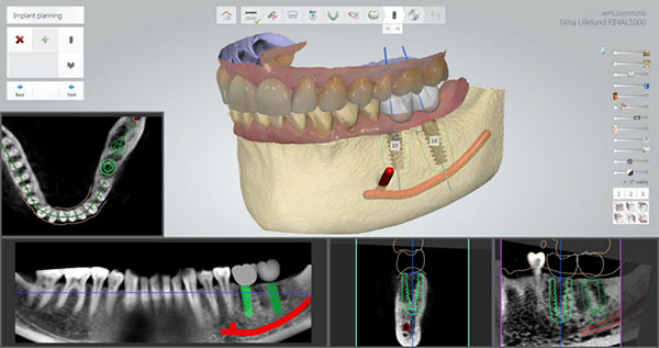 Nobel Biocare Implant Sudio